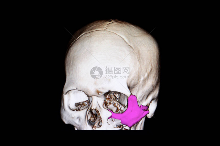 对创伤脑部受伤患者的头骨进行CT扫描图片