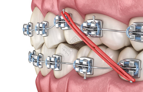 用于矫正牙咬口的利器和金属牙套插画