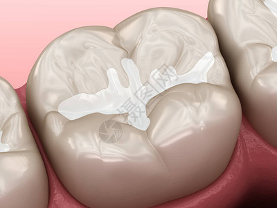 MolarFissure牙科填充物医学准确的牙科图片