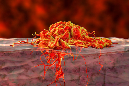 黑色素入侵癌症增长3D图例显示肿瘤侵设计图片