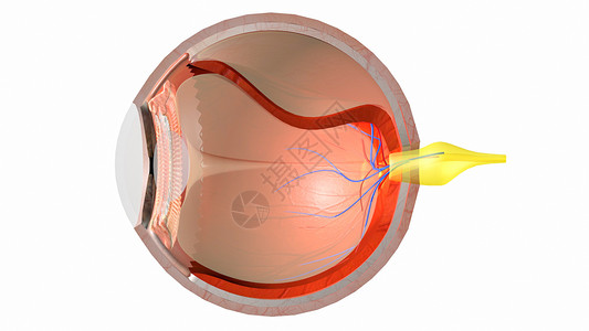 左巩膜视网膜脱落设计图片