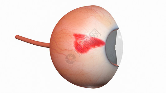 右晶状体结膜下出血设计图片