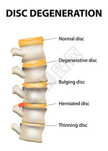 退思园椎间盘退变是脊椎老化的正常磨损过程椎间盘失去弹弹插画