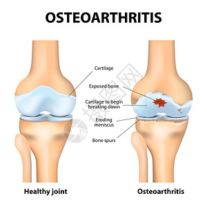 骨关节炎关节炎或关节内的疼痛退行关节病软骨磨损这会导致关节发炎图片