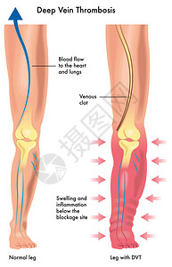 深静脉血栓形成图片