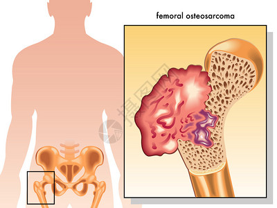 人类股骨肉瘤背景图片