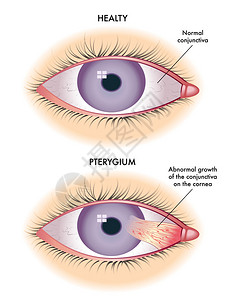 翼状胬肉症状的医学插图背景图片