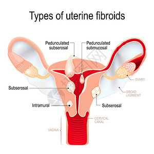 子宫肌瘤子宫平滑肌瘤类型浆膜下肌壁间黏膜下插画
