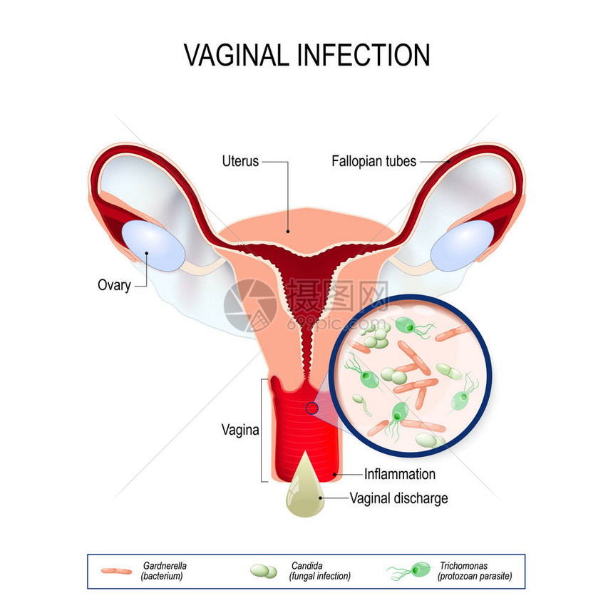 阴道的阴道感染及致病因子图片