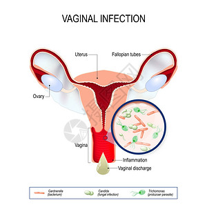 鹅口疮阴道的阴道感染及致病因子插画