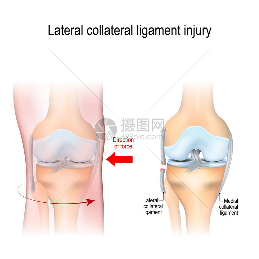 腓侧副韧带损伤关节解剖用于生物医学科学和教育用图片