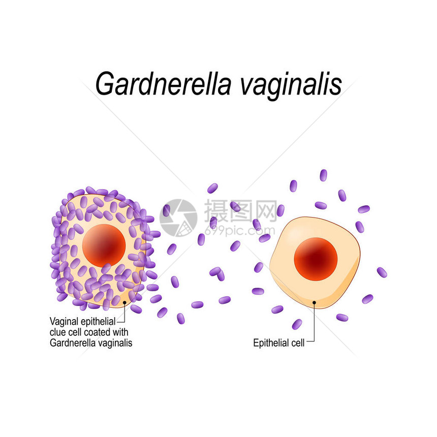 阴道加德纳瑞拉生殖器感染阴道上皮线索细胞包被细菌细菌阴道病传播感染用于生物科学医学用途的插图图片