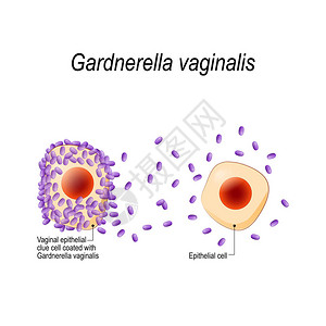 鹅口疮阴道加德纳瑞拉生殖器感染阴道上皮线索细胞包被细菌细菌阴道病传播感染用于生物科学医学用途的插图插画