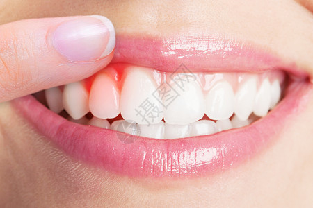 牙龈肿痛健康的牙齿高清图片