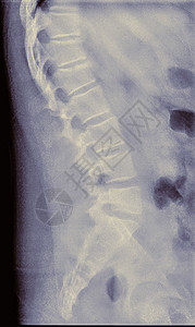 14岁男性左二椎体侧视压缩性骨折的X线表现图片