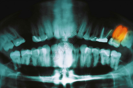 牙科X射线图片
