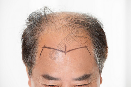 植发治疗中年男性植发手术背景
