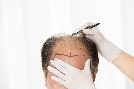 中年男性植发手术背景
