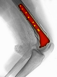 骨折断裂的大腿膝部修补X光图片