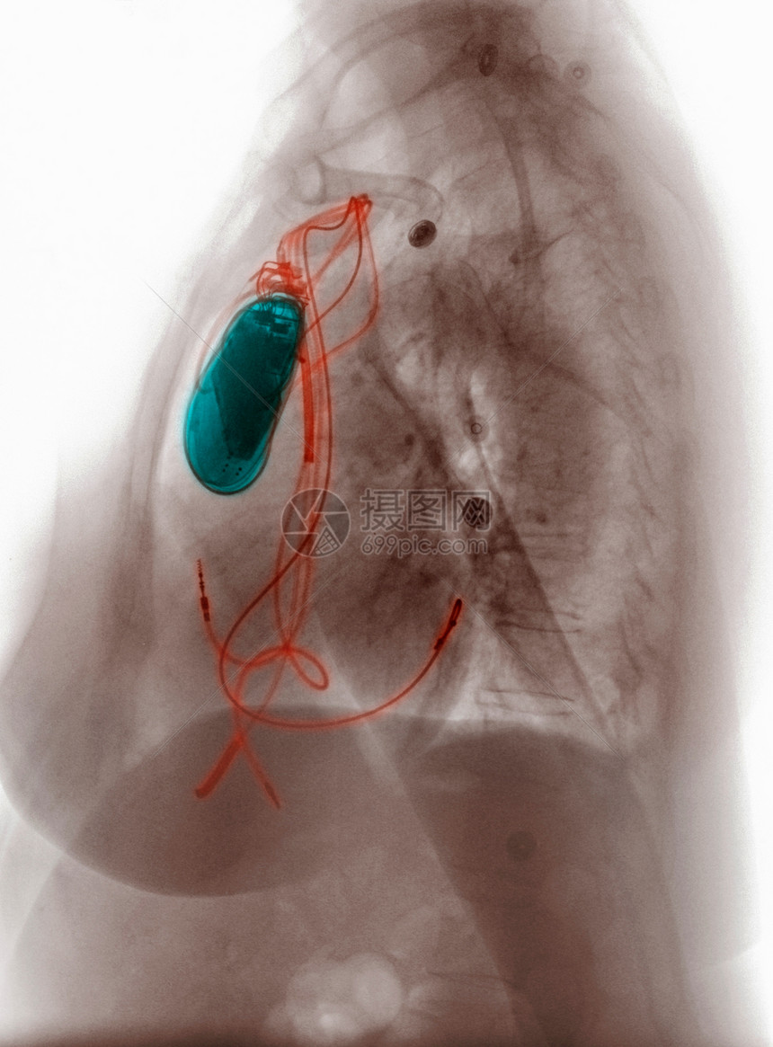 切片X光显示植入式铅铸造器图片