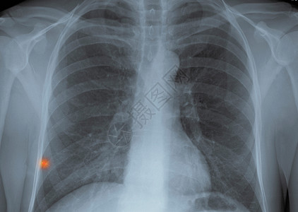 肺部有金属异物的胸部X光片图片