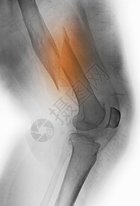 股骨折X射线图片