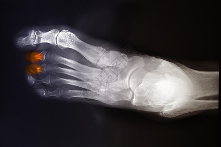 糖尿病的足骨畸形X光图片