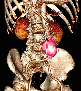 CT显示腹部动脉图像图片