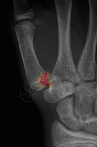 X光显示拇指底部骨折图片