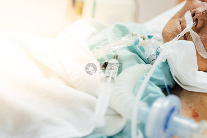 80多岁的亚洲老年女患者在医院重症监护室ICU病房的病床上使用呼吸机进行气管切开术进行图片
