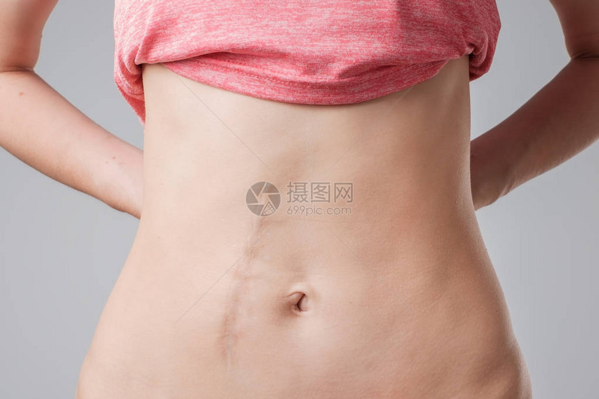 在手术后长腹部伤疤的欧裔妇女图片
