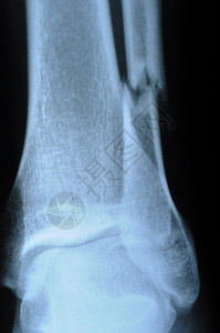 人腿X光片断腿图片