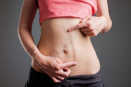 欧洲妇女在手术后长腹部疤痕的欧裔妇女图片