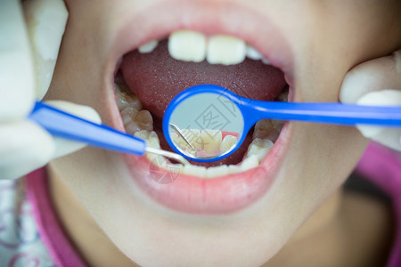 使用清洁微积分擦牙的结缝牙科医生程序图片