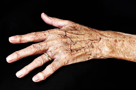 老妇人痛苦的手一位老妇人的手疼一图片