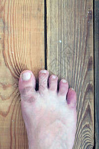 足部疾病皮肤感染特写图片