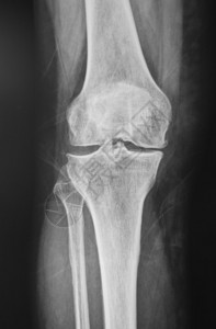 X射线正常膝关节的集合图片