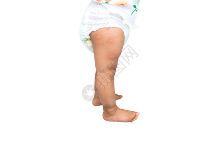 新出生的婴儿腿上多蚊虫咬伤白色背景背景图片