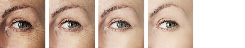 妇女眼部在手术前后的皱纹调整程图片