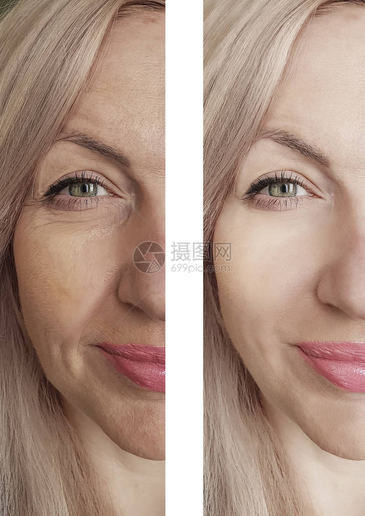 在手术前后妇女的皱纹脸部都长在手图片