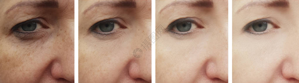 妇女眼部皱纹在治疗前后和治疗图片