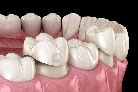 牙体缺损Porcelain王冠放置在前摩尔牙和磨牙上医学精设计图片