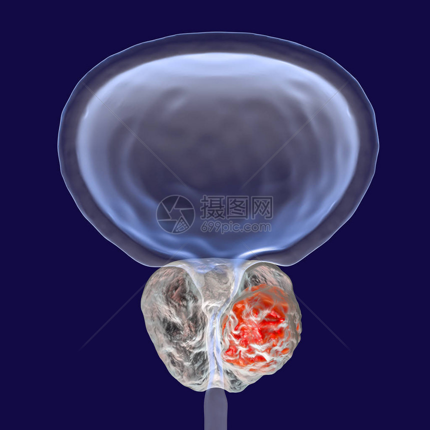 前列腺癌3D图解显示前列腺内有肿瘤图片