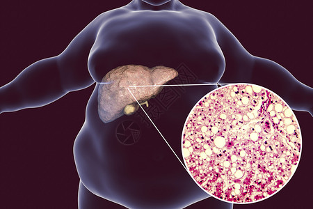患有脂肪肝脏3D图解和肝胃病照片显微镜的肥胖男子非酒精脂肪肝病背景图片