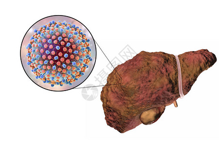 黄肉油桃肝硬化阶段丙型肝炎感染的肝脏和丙型肝炎HCV3D插设计图片