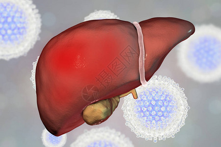 丙肝炎感染的肝脏炎CHC图片
