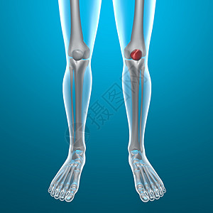 人腿X光图片
