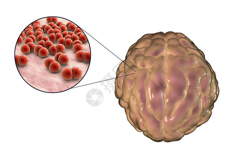 由链球菌引起的脑膜炎感染图片