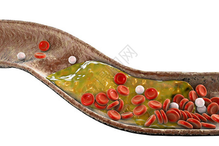 动脉硬化动脉中的胆固醇斑块3D插图冠状设计图片