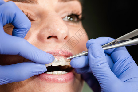 修复女病人牙齿上隐形陶瓷牙图片